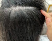 头顶长白头发的原因有哪些呢？遗传因素是关键